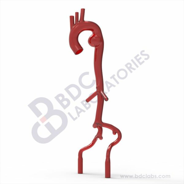 Thoracic Aortic Aneurysm