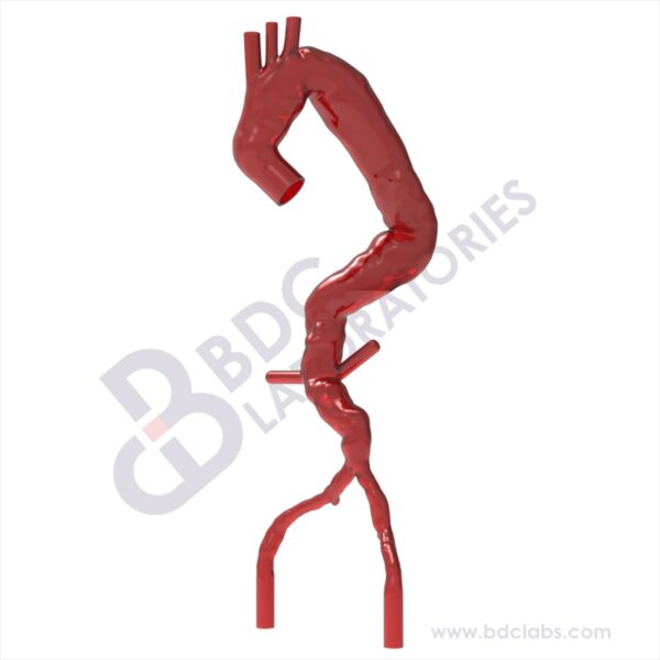 Thoracic Aortic Aneurysm