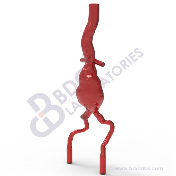 Abdominal Aortic Aneurysm