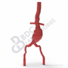 Abdominal Aortic Aneurysm - Image 2