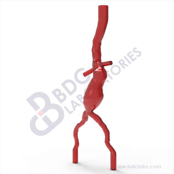 Abdominal Aortic Aneurysm