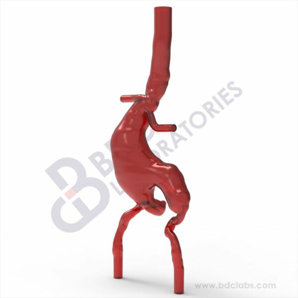 Abdominal Aortic Aneurysm