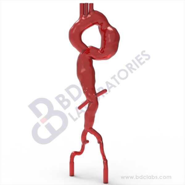Thoracic Aortic Aneurysm