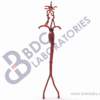 Aorta with Femoral and Neurovascular Arteries with Aneurysms - Image 2