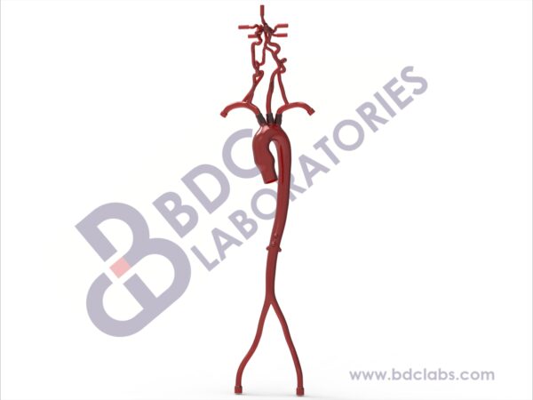 Aorta with Femoral and Neurovascular Arteries with Aneurysms