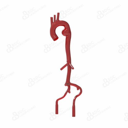 Thoracic Aortic Aneurysm