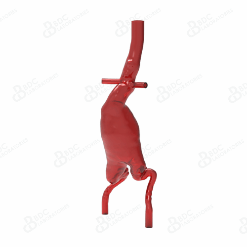 Abdominal Aortic Aneurysm