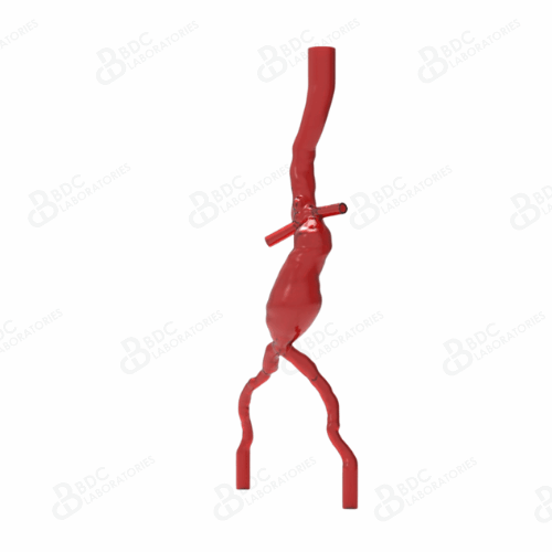 Abdominal Aortic Aneurysm