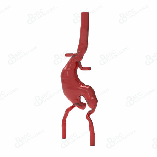Abdominal Aortic Aneurysm