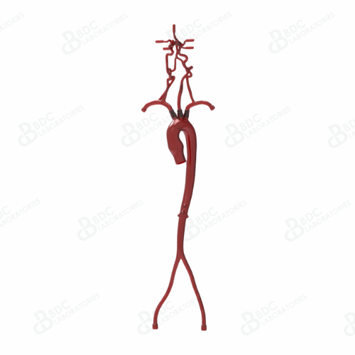 Aorta with Femoral and Neurovascular Arteries with Aneurysms